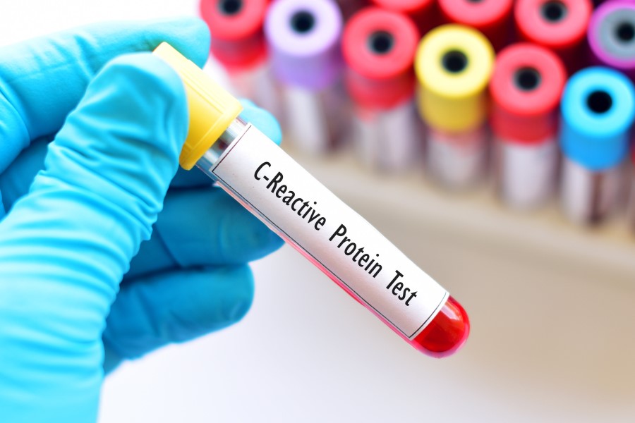 Diagnosta trzyma w dłoni fiolkę z krwią do badania CRP.