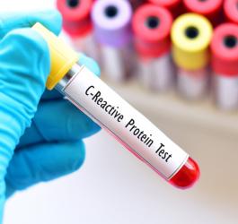 Diagnosta trzyma w dłoni fiolkę z krwią do badania CRP.