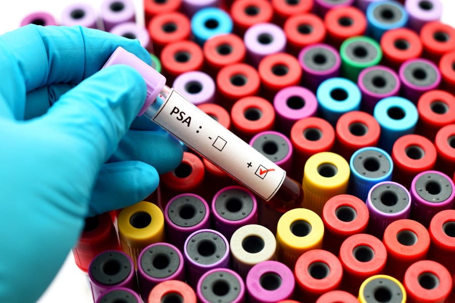 Próbka krwi w ręce diagnosty, przeznaczona do badania PSA.