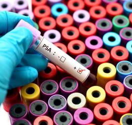 Próbka krwi w ręce diagnosty, przeznaczona do badania PSA.