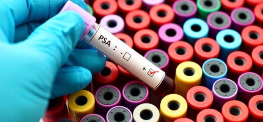 Próbka krwi w ręce diagnosty, przeznaczona do badania PSA.