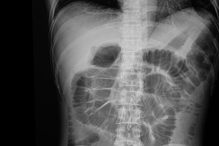 Zdjęcie rentgenowskie jamy brzusznej.