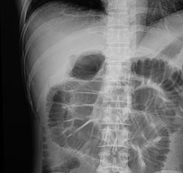 Zdjęcie rentgenowskie jamy brzusznej.