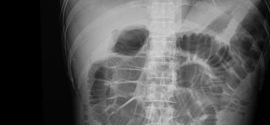 Zdjęcie rentgenowskie jamy brzusznej.