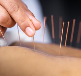 Pacjent podczas zabiegu akupunktury.