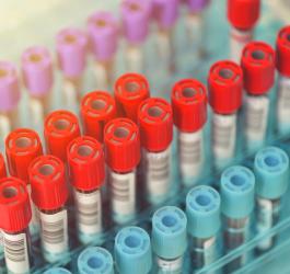 Próbki krwi przeznaczone do badań diagnostycznych.