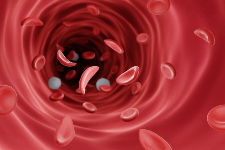 Krwinki w kształcie sierpa, charakterystyczne dla anemii sierpowatej.