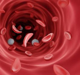 Krwinki w kształcie sierpa, charakterystyczne dla anemii sierpowatej.