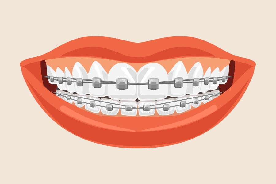 Aparat ortodontyczny - czy warto prostować zęby?