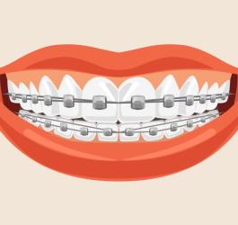 Aparat ortodontyczny - czy warto prostować zęby?