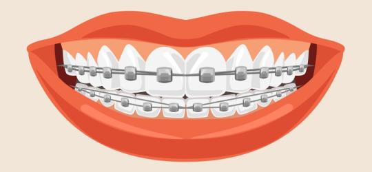 Aparat ortodontyczny - czy warto prostować zęby?