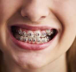 Aparat ortodontyczny - kiedy zdecydować się na jego założenie? 
