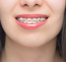 Kobieta ma na zębach aparat samoligaturujący.