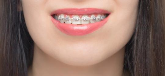 Kobieta ma na zębach aparat samoligaturujący.