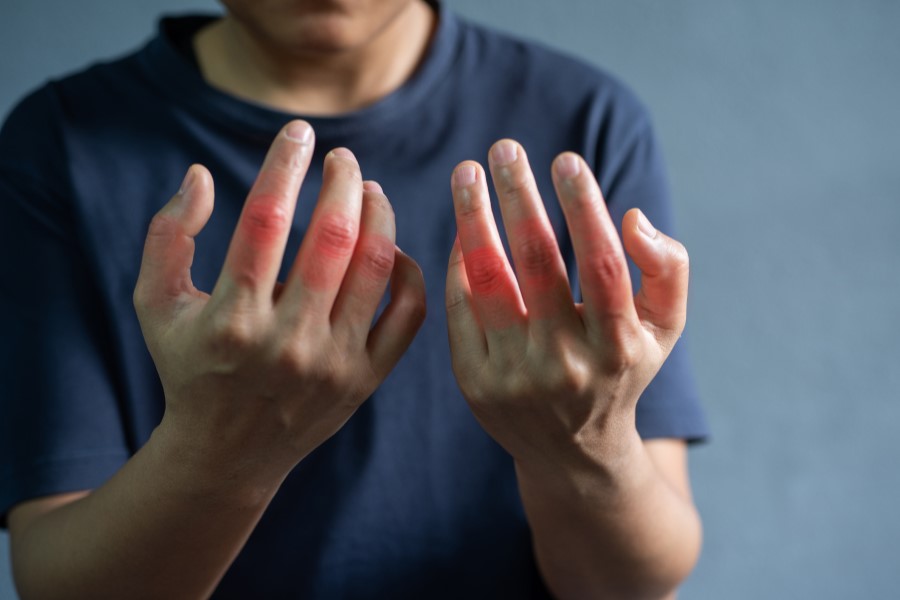 Mężczyzna zmaga się ze stanem zapalnym stawów, typowym przy artretyzmie.