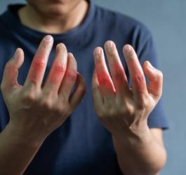 Mężczyzna zmaga się ze stanem zapalnym stawów, typowym przy artretyzmie.