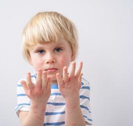 Smutny chłopiec z widocznym atopowym zapaleniem skóry.