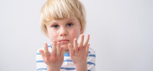 Smutny chłopiec z widocznym atopowym zapaleniem skóry.