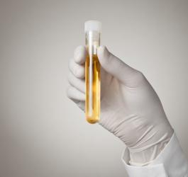 Próbka moczu trzymana przez osobę w lateksowych rękawiczkach.