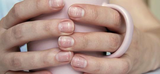 Kobieta trzyma w dłoniach kubek, ma liczne białe plamy na paznokciach.