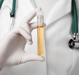 Lekarz trzymający w dłoni próbkę moczu pacjenta.