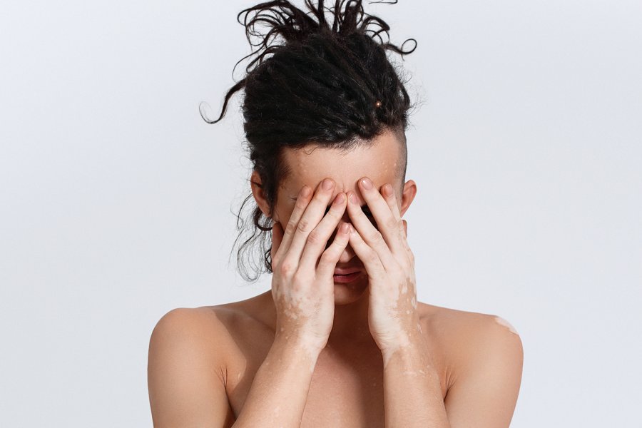 Bielactwo nabyte - objawy i leczenie