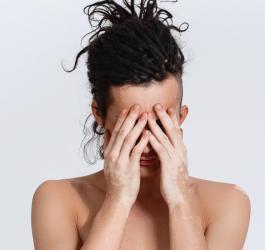 Bielactwo nabyte - objawy i leczenie