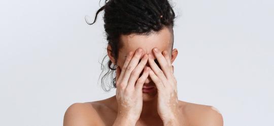 Bielactwo nabyte - objawy i leczenie