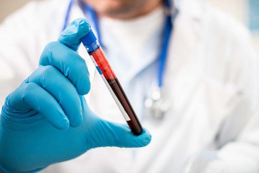 Diagnosta trzymający fiolkę z krwią przeznaczoną do badania bilirubiny bezpośredniej.