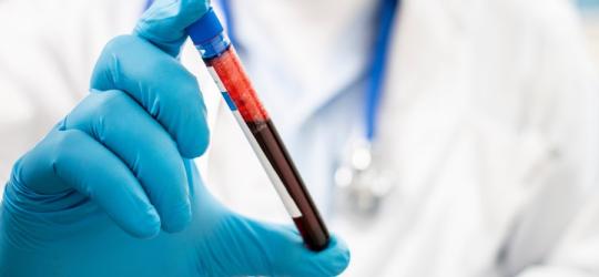 Diagnosta trzymający fiolkę z krwią przeznaczoną do badania bilirubiny bezpośredniej.