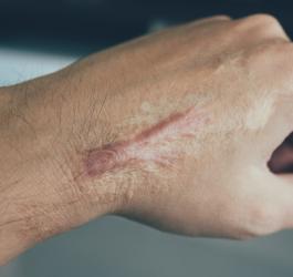 Dłoń mężczyzny z przerośniętą blizną (bliznowcem).