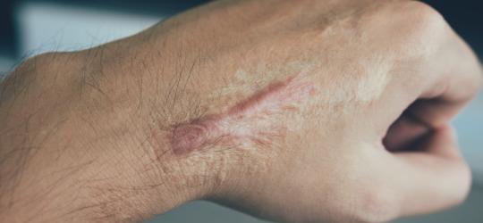 Dłoń mężczyzny z przerośniętą blizną (bliznowcem).