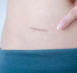 Kobieta pokazuje palcem bliznę na skórze.