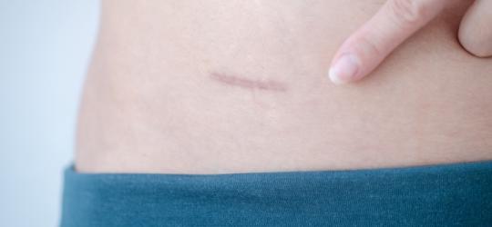 Kobieta pokazuje palcem bliznę na skórze.