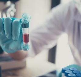 Diagnosta trzyma w ręce próbkę krwi do badania poziomu ceruloplazminy.