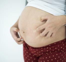 Kobieta drapie się po ciążowym brzuchu, bo swędzi ją skóra, co może być objawem cholestazy ciążowej.