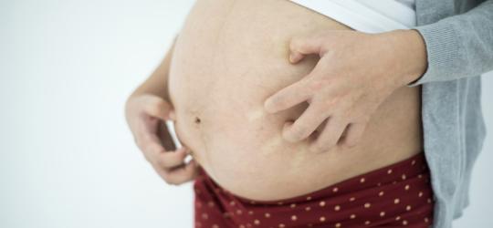 Kobieta drapie się po ciążowym brzuchu, bo swędzi ją skóra, co może być objawem cholestazy ciążowej.