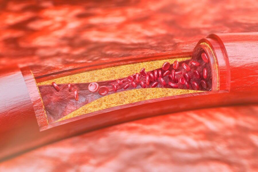 Cholesterol w żyłach pacjenta.