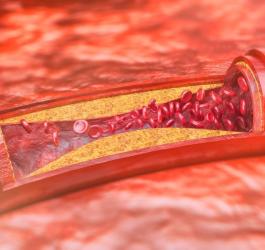 Cholesterol w żyłach pacjenta.