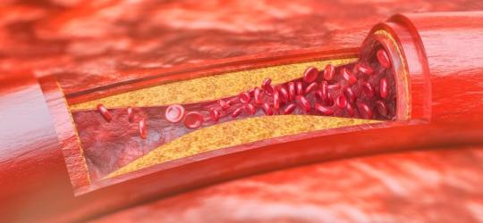Cholesterol w żyłach pacjenta.