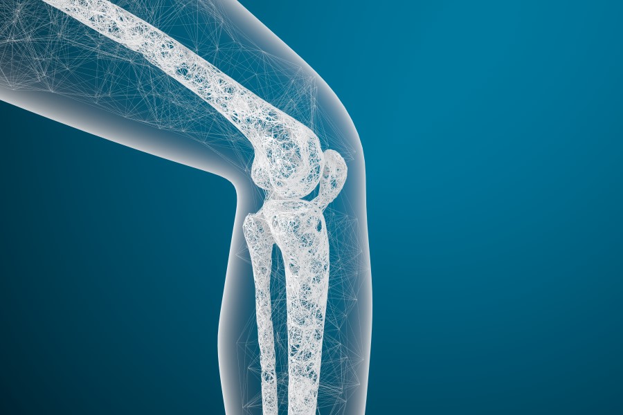 Grafika 3D przedstawiająca budowę stawu kolanowego, w tym rzepki z widoczną chondromalacją.