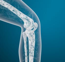 Grafika 3D przedstawiająca budowę stawu kolanowego, w tym rzepki z widoczną chondromalacją.