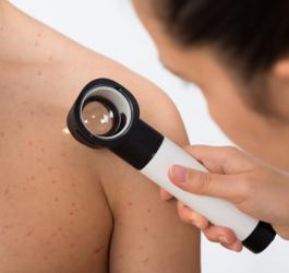 Dermatolog bada skórę pacjenta dermatoskopem w celu potwierdzenia choroby Dariera.