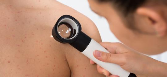 Dermatolog bada skórę pacjenta dermatoskopem w celu potwierdzenia choroby Dariera.