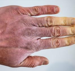 Różne zabarwienie skóry dłoni, typowe dla choroby Raynauda.