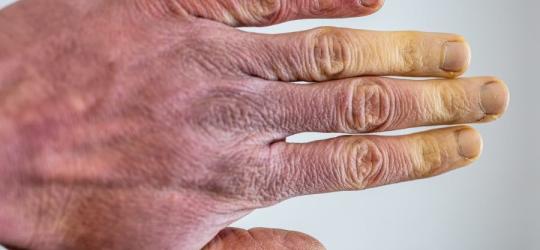 Różne zabarwienie skóry dłoni, typowe dla choroby Raynauda.