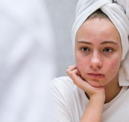 Dziewczyna spogląda na swoje odbicie w lustrze. Skóra jest zaatakowana trądzikiem.