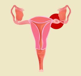 Ciąża pozamaciczna