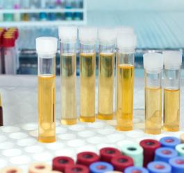 Co oznacza białko w moczu?