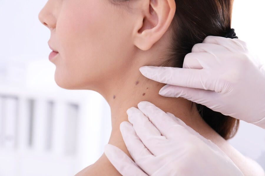 Czerniaki: jak rozpoznać raka skóry?